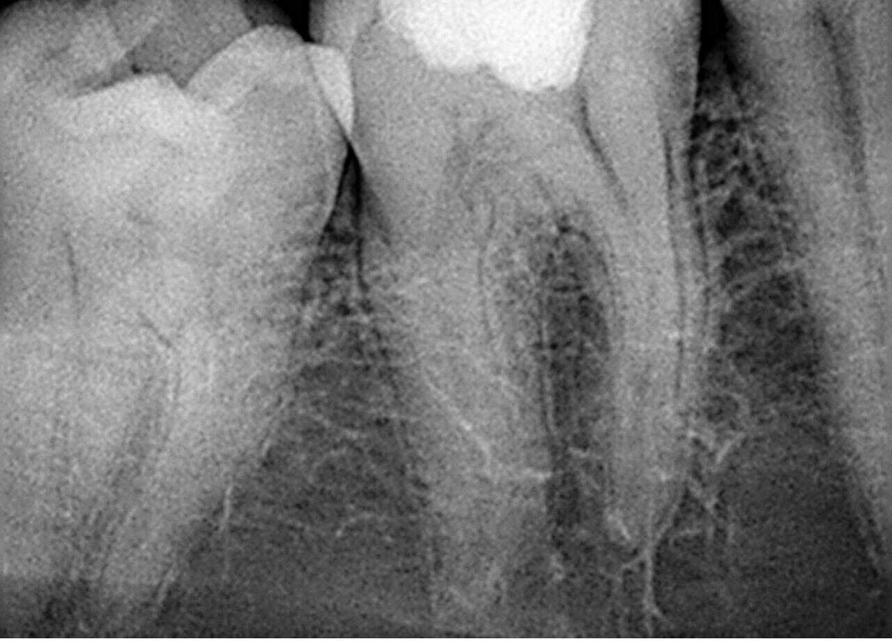 Radiografía de un molar antes del tratamiento de conductos