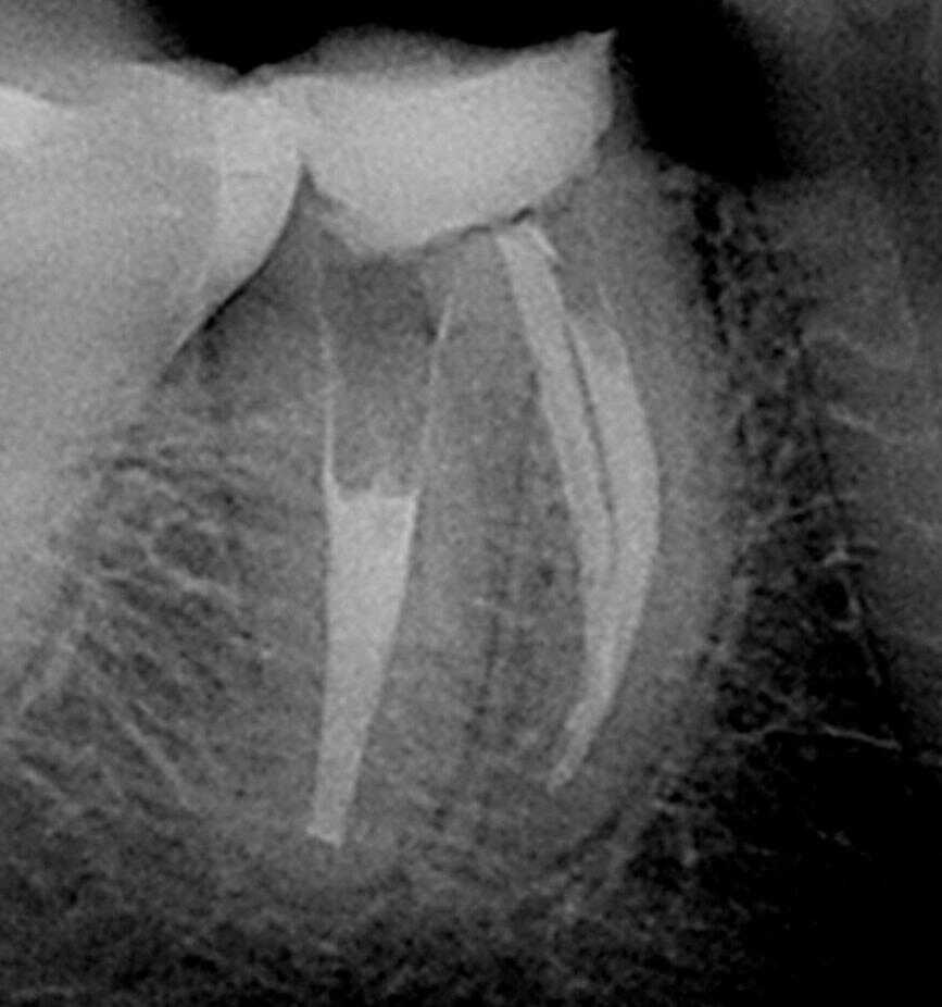 Radiografía dental de un diente después del tratamiento de endodoncia en Hermosillo