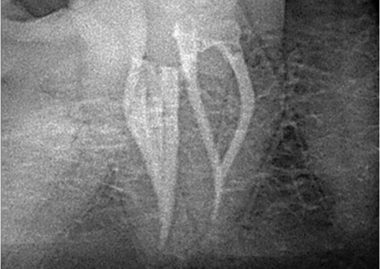Radiografía de un diente después del tratamiento de endodoncia