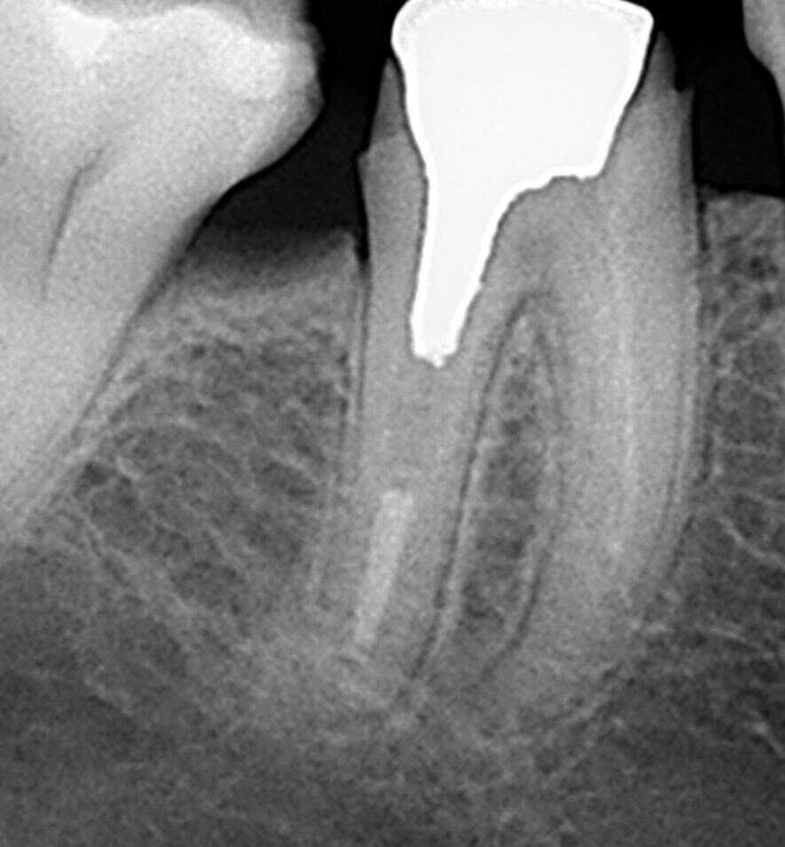 Radiografía de un diente antes del tratamiento de conductos